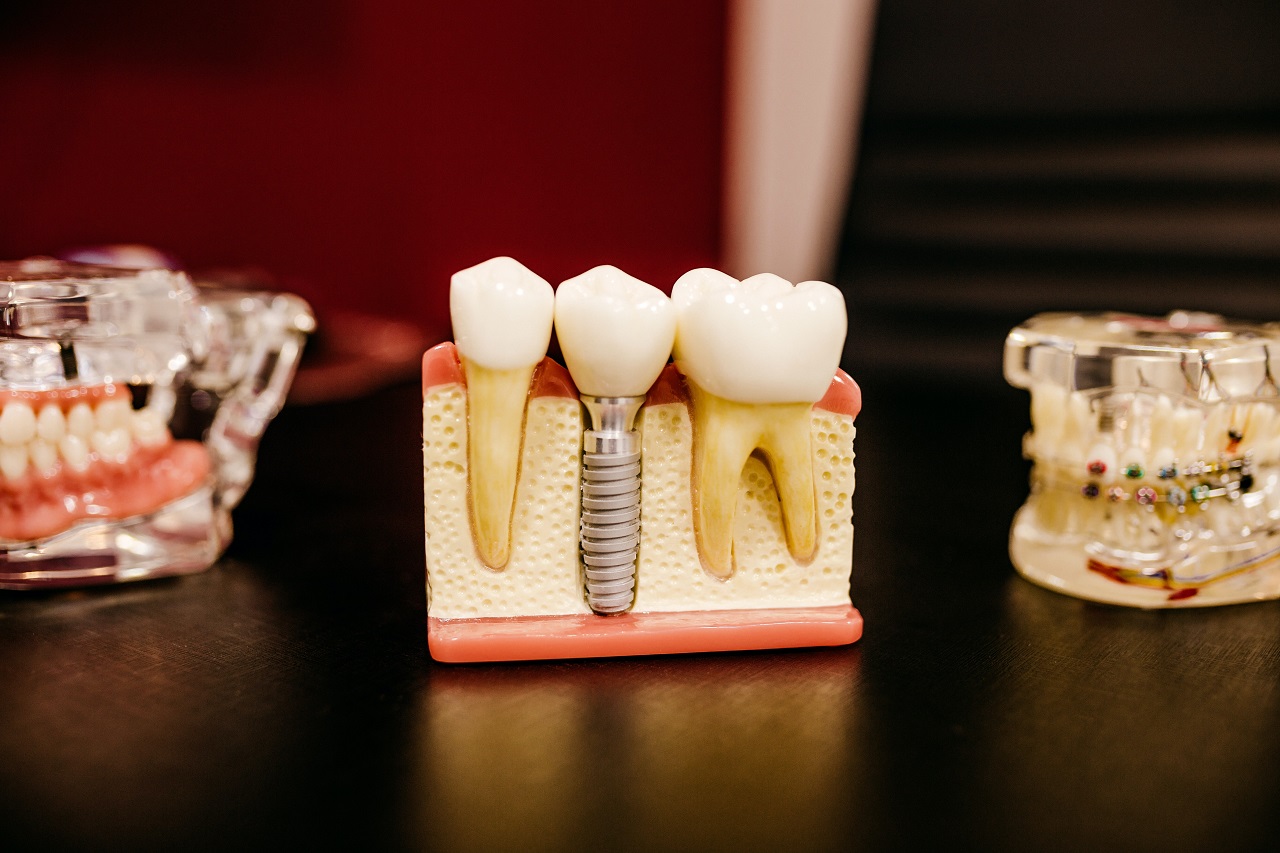 Jak są zakładane implanty zębowe?